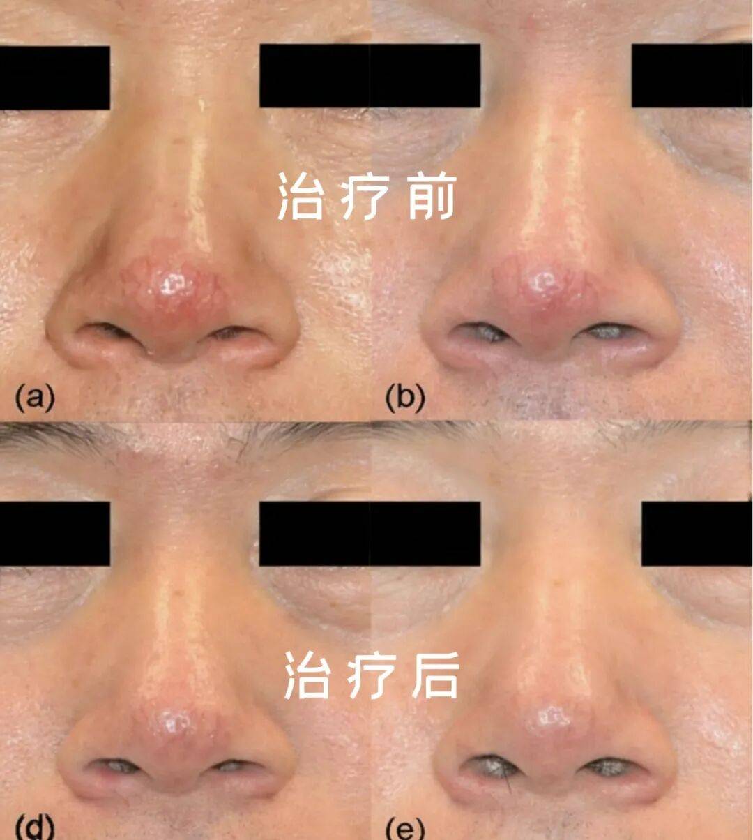 美麗的誤會：當“玫瑰”不是花，而是玫瑰痤瘡