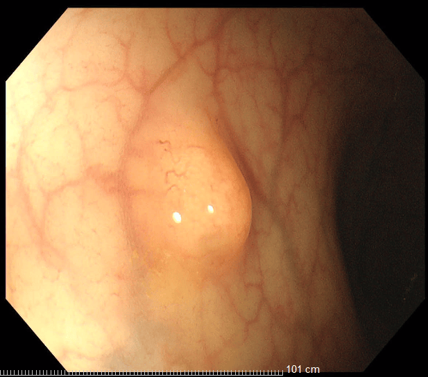 發現早期腸道腫瘤，胃腸鏡檢查很有必要