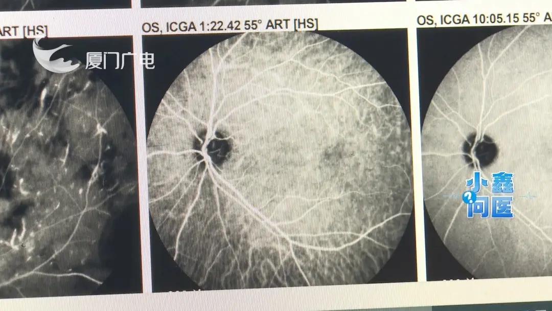 45歲女子自行打美容針，右眼突然失明！醫生：已不可逆