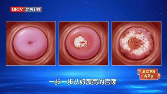 大部分女性都躲不過的病毒，反覆感染易癌變，兩個高危年齡段尤其要注意......